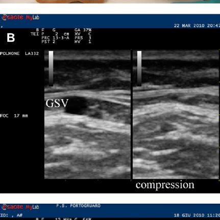 Extended Compression Ultrasound Performed by Emergency Phy